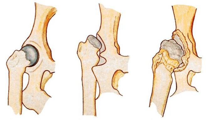 Hip dysplasia is a cause of secondary hip arthropathy
