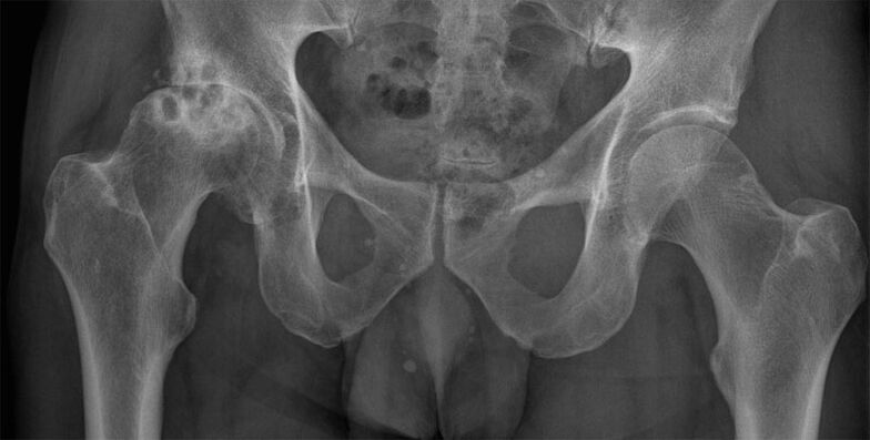 X-ray shows stage 3 arthrosis of hip joint