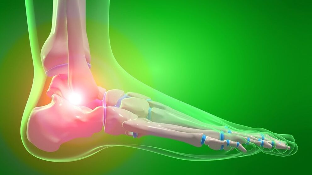 Ankle arthropathy