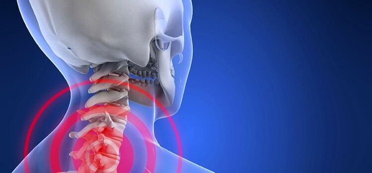 Osteochondral disease in the cervical area