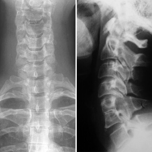 X-Cervical vertebrae rays