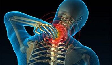 Symptoms of cervical osteochondrosis