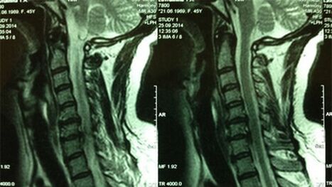 MRI of the cervix