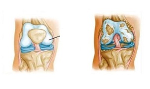 Pathological changes of knee arthritis