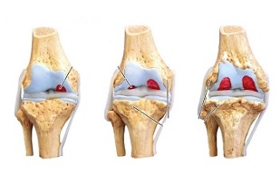 Stages of knee arthritis