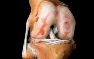 What is knee joint disease