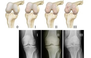 Diagnosis of knee joint disease