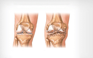 Knee joint disease