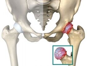 Causes of hip atrophy