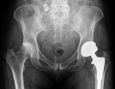 Diagnosis of hip arthritis