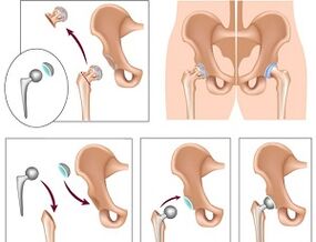 Joint replacement for hip arthritis