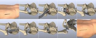 Methods of treating hip joint disease