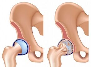 Symptoms of hip arthritis