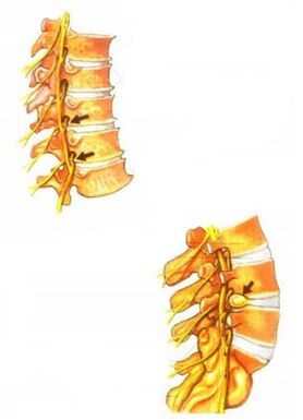 Illustration of spine osteochondrosis