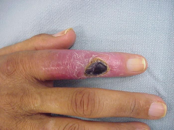 Osteomyelitis causes finger joint pain