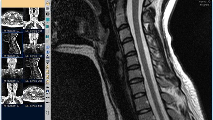 Cervical MRI is the best way to diagnose neck pain