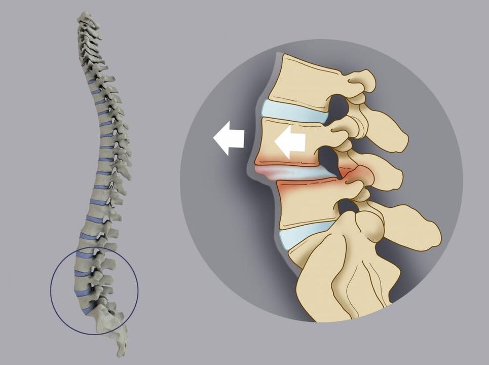 Back pain caused by vertebrae displacement